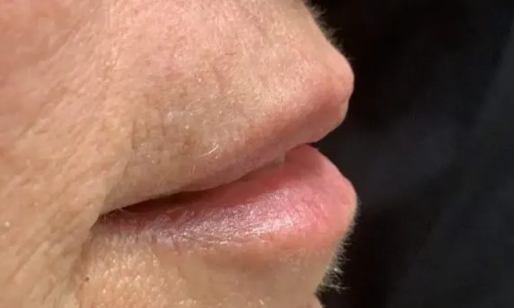 Clinical photo from Sally's lip enhancement case